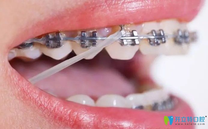 梁美德医生解析：牙齿矫正中的橡皮筋有什么作用