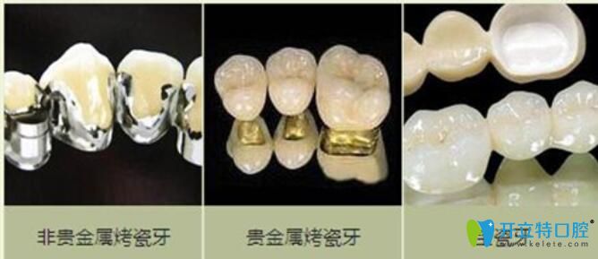 烤瓷牙种类 烤瓷牙种类