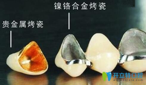 烤瓷牙 烤瓷牙