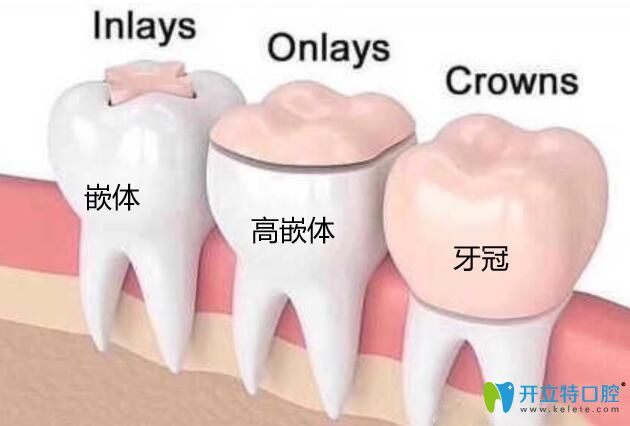高嵌体和牙冠的区别 高嵌体和牙冠的区别