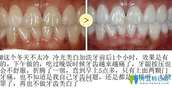 冷光美白前后效果对比图