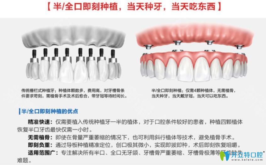all-on-4种植牙技术优势