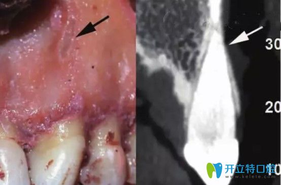 骨开窗牙齿及CT照片