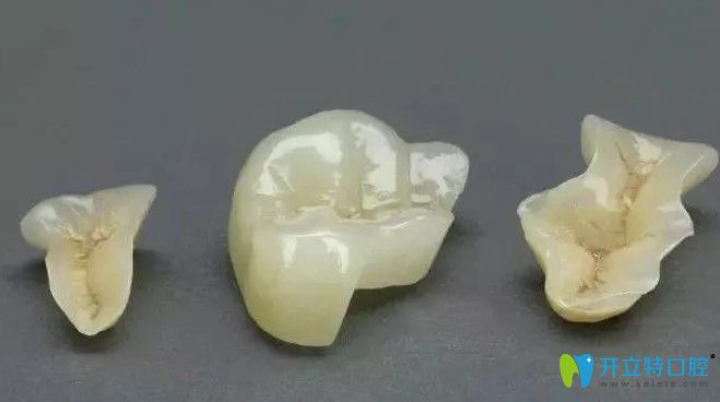 选择嵌体补牙的原因有哪些