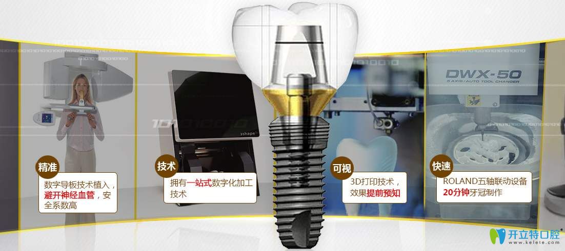 数字化种植牙