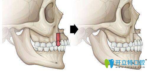 拔牙后前后对比