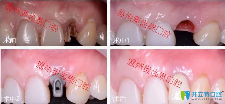 温州奥齿泰口腔龋齿拔牙后做即刻种植牙案例分享,不当不管不顾佛系缺牙者