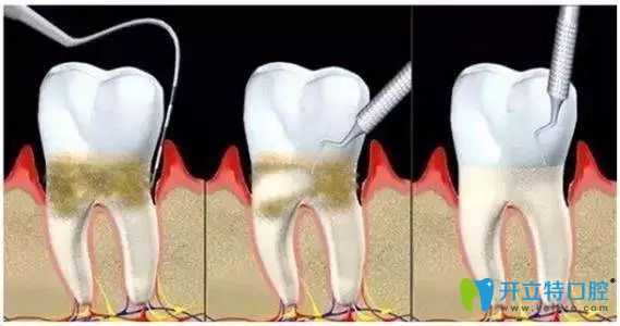 牙周炎治疗过程