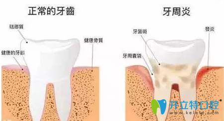 正常的牙齿和牙周炎