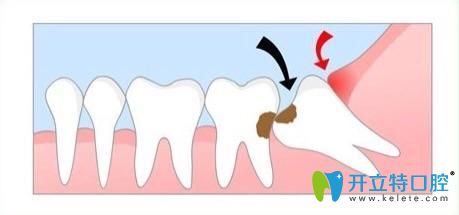 矫正时候需要拔掉龋齿