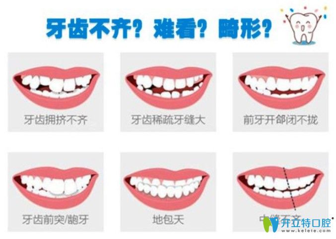 哪些牙齿情况可以做ormco自锁托槽矫正