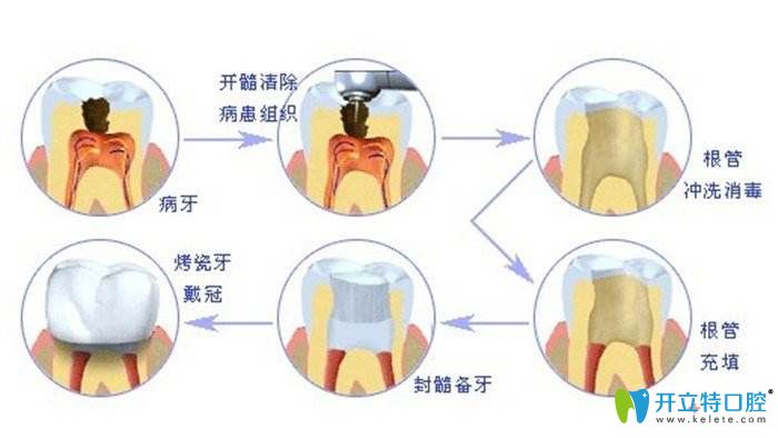 根管治疗的过程