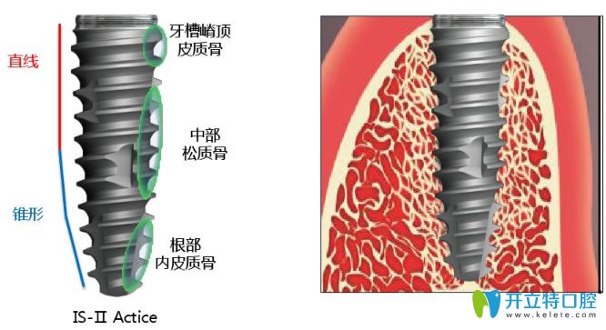 韩国纽百特种植体优点 韩国纽百特种植体优点