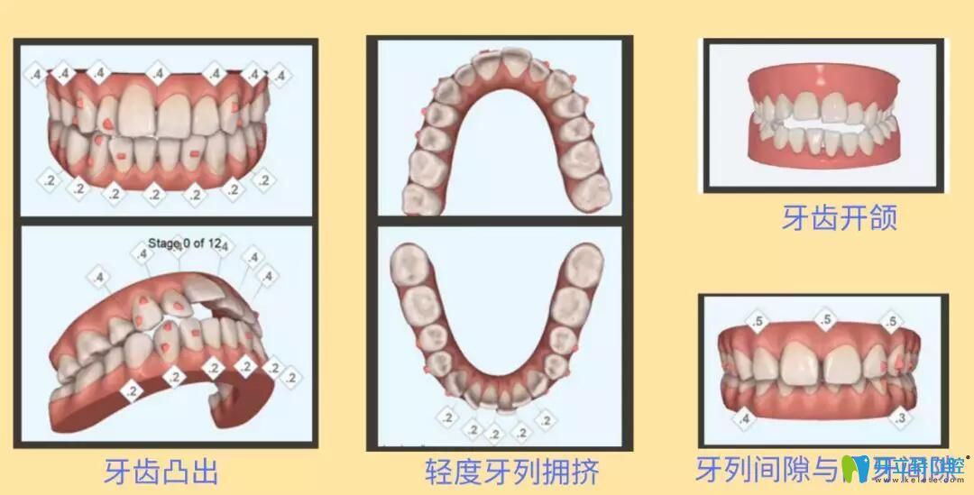 隐适美igo适应人群