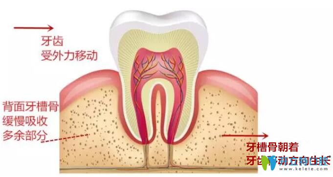 牙齿矫正中牙齿的移动原理