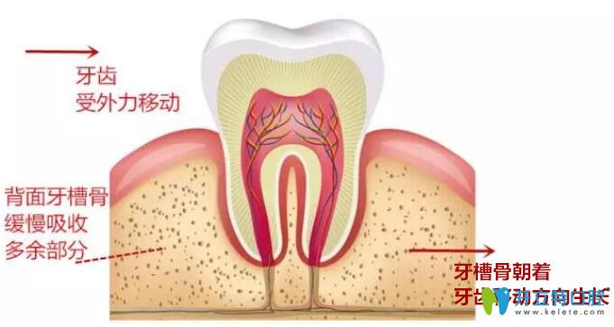 牙齿矫正中牙齿的移动原理 牙齿矫正中牙齿的移动原理
