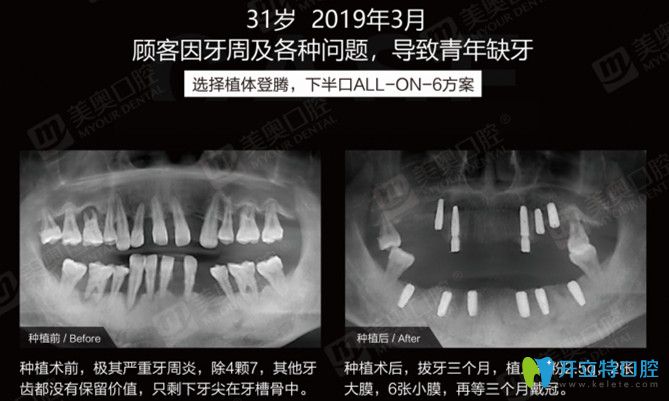 长沙美奥口腔实锤！有案例证实患牙周炎照样可以做ALL-ON-6半口种植牙