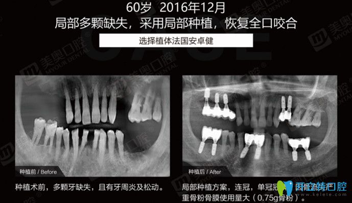 局部多颗牙缺失采用局部种植12颗牙齿