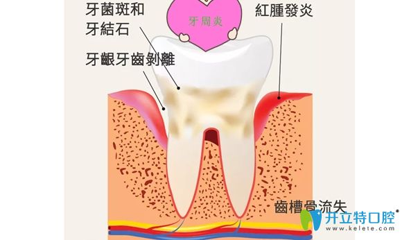 其实引起牙齿过早脱落的原因有一半是牙周炎所为!