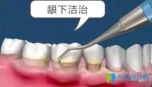 常规洗牙和龈下深刮治是有效治疗牙周病的方法