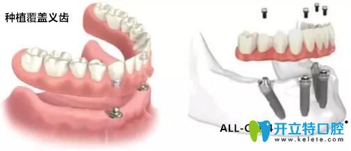 all-on-4和覆盖义齿的区别