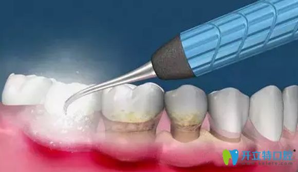 超声波洁牙是预防和治疗轻度牙周炎的方法
