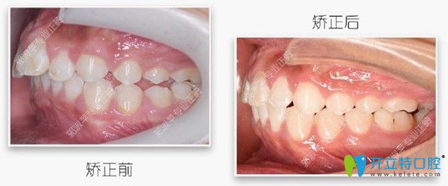 深覆盖矫正前后图片