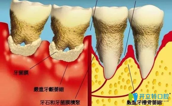 牙周炎加重牙齿就会因此提前脱落