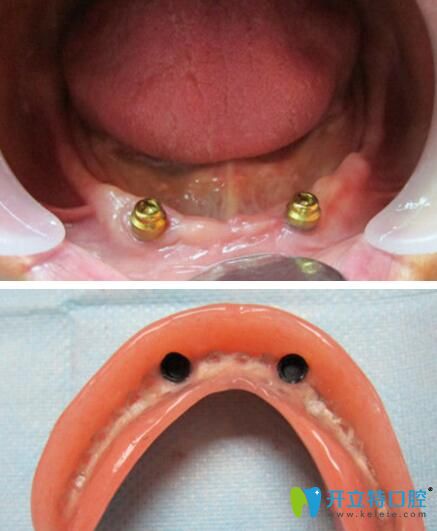 覆盖义齿修复比种植牙价格便宜还比全口活动假牙耐用