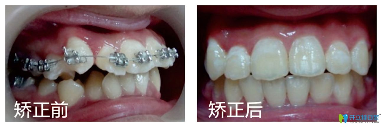修大夫口腔龅牙矫正前后效果对比图