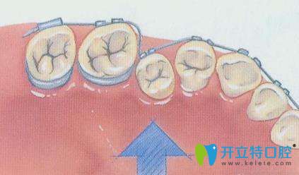 牙齿矫正示意图 牙齿矫正示意图