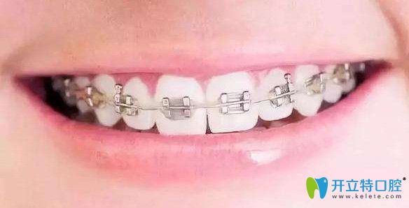 瑞德口腔传统金属托槽矫正器