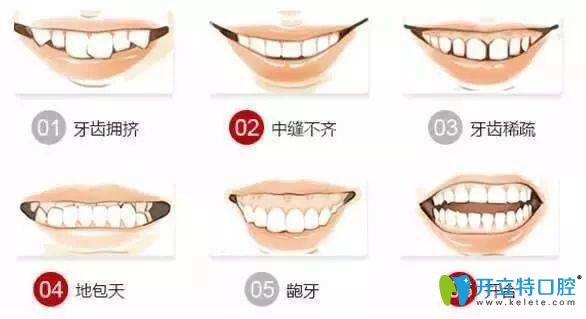 牙齿不齐的情况 牙齿不齐的情况