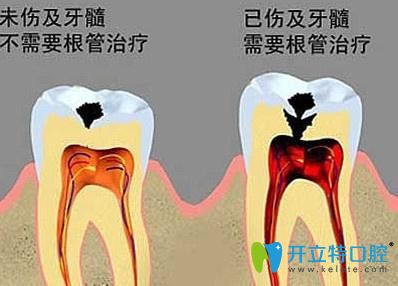 蛀牙修复选择补牙和根管治疗哪一种