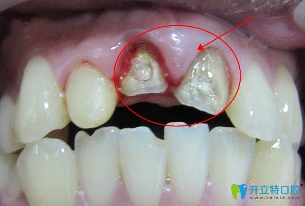 全瓷牙基牙发生根尖炎也会引起吃东西疼痛