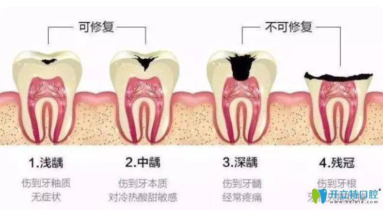 牙齿缺失为啥要做根管治疗
