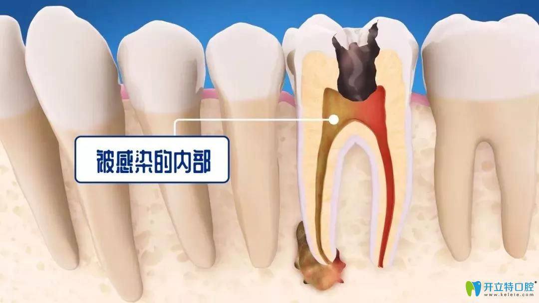 牙齿龋坏伤及牙髓要做根管治疗