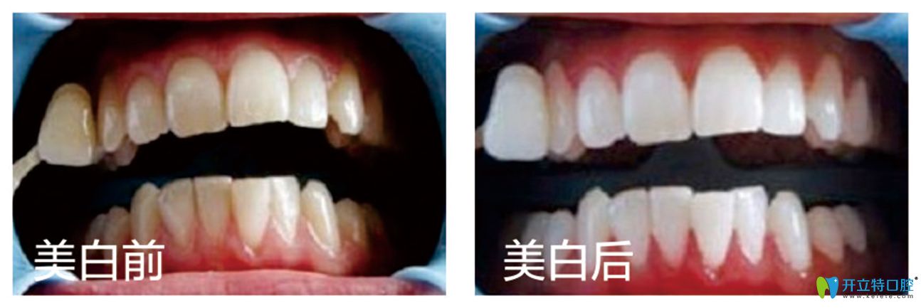 泉州晋江修大夫牙科皓齿美白案例 泉州晋江修大夫牙科皓齿美白案例