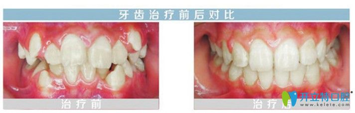 舌侧隐形牙套矫正虎牙前后对比照