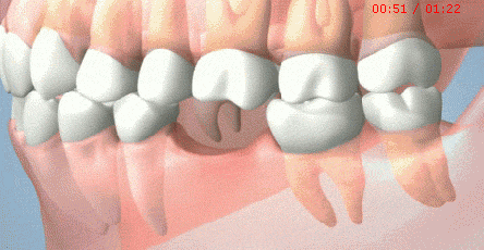 牙齿缺失要及时修复