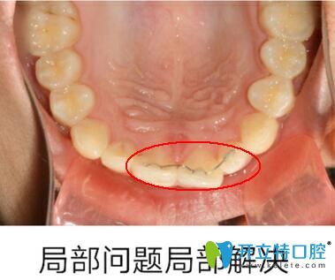 微管矫正单颗牙齿不齐 微管矫正单颗牙齿不齐