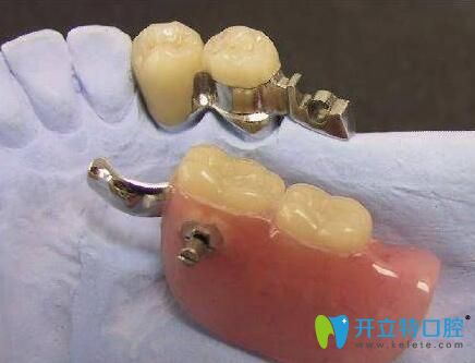 精密附着体义齿和普通义齿除了价格不同,还有啥区别？