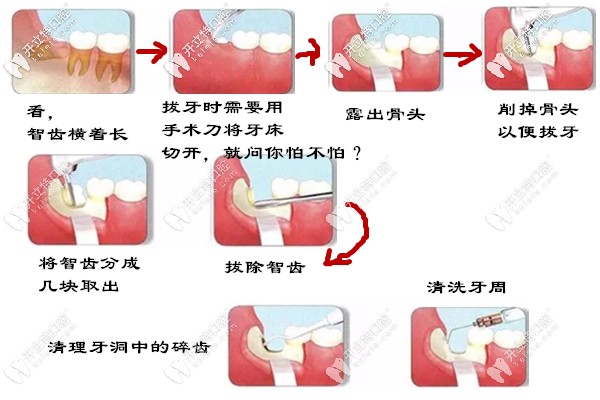 微创拔智齿的过程图解图片