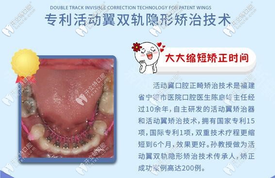 广州德系口腔双轨舌侧隐形矫正技术
