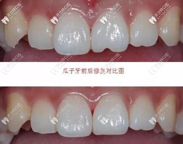 树脂材料修复瓜子牙前后对比图