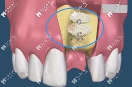 种植牙填骨粉的位置