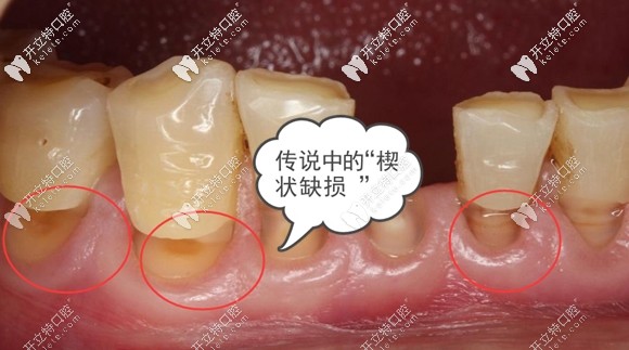 牙齿楔状缺损怎么治疗图片