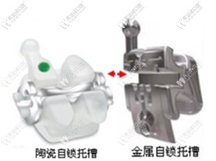 自锁托槽图片 自锁托槽图片