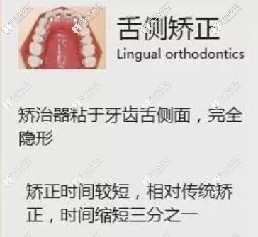 舌侧矫正优点 舌侧矫正优点