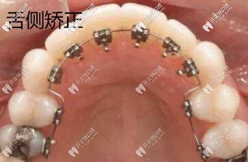 舌侧矫正图片 舌侧矫正图片